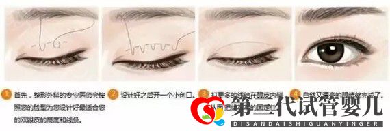 埋線雙眼皮恢復期要多少時間?(圖1) 埋線雙眼皮恢復期要多少時間?(圖1)