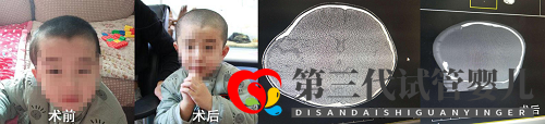 合肥哪家醫院可以做顱骨修補術(圖1) 合肥哪家醫院可以做顱骨修補術(圖1)