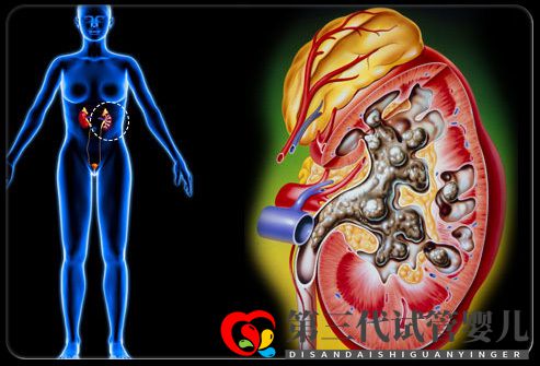 成都哪家醫院可以治療腎結石？不可錯過！(圖1)