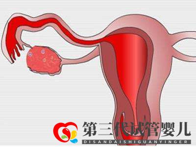 子宮肌瘤做俄羅斯試管嬰兒的成功率高嗎?(圖1) 子宮肌瘤做俄羅斯試管嬰兒的成功率高嗎?(圖1)