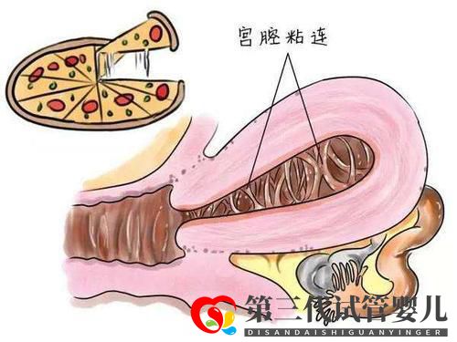 子宮粘連可以做試管嬰兒?jiǎn)幔砍晒β矢卟桓撸?圖2)