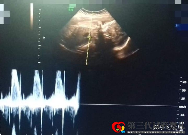 我終于懷上了!辛酸三代試管經(jīng)歷!大家接好孕!(圖4) 我終于懷上了!辛酸三代試管經(jīng)歷!大家接好孕!(圖4)