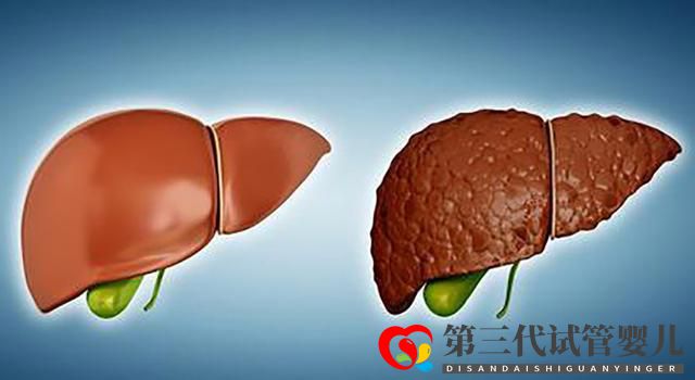 老年肝硬化的原因有哪些？醫生：多數可以避免(圖2)