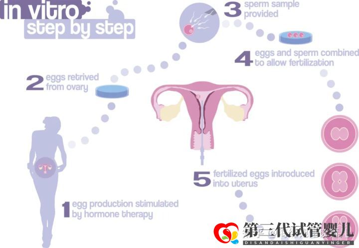 試管嬰兒1代、2代、3代、4代哪個最好真實操作過...(圖4) 試管嬰兒1代、2代、3代、4代哪個最好真實操作過...(圖4)