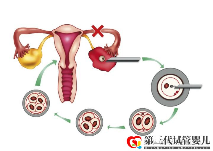試管嬰兒1代、2代、3代、4代哪個最好真實操作過...(圖8) 試管嬰兒1代、2代、3代、4代哪個最好真實操作過...(圖8)