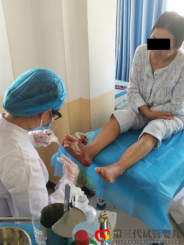 糖尿病并發(fā)癥糖尿病足到底有多可怕，可以避免截肢嗎？(圖2)
