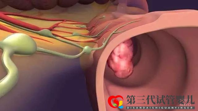 研究：基因操縱結腸癌細胞中的蛋白質水平可以改善化療情況(圖3)
