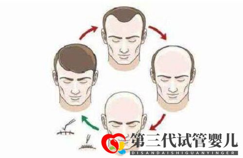 植發(fā)可以解決禿頂或頭發(fā)稀少的問題嗎?頭發(fā)種植多久見效呢?(圖1) 植發(fā)可以解決禿頂或頭發(fā)稀少的問題嗎?頭發(fā)種植多久見效呢?(圖1)