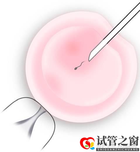關(guān)于試管嬰兒,你想知道的都在這里,不懂就得多看看(圖2) 關(guān)于試管嬰兒,你想知道的都在這里,不懂就得多看看(圖2)
