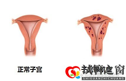 33歲子宮畸形多年未孕,如何提高試管成功率(圖2)