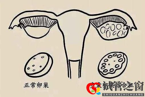 多囊促排懷孕成功率大嗎？(圖1)