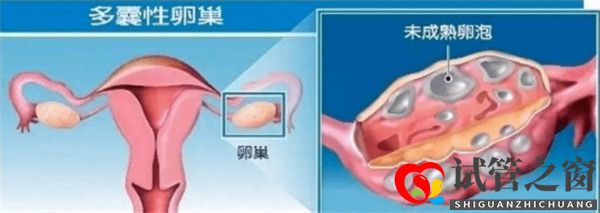 多囊卵巢綜合征對試管嬰兒成功率有哪些影響如何及時調(diào)理(圖1)