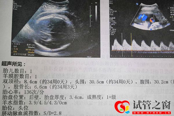 試管嬰兒一超確定胎兒是否宮內妊娠