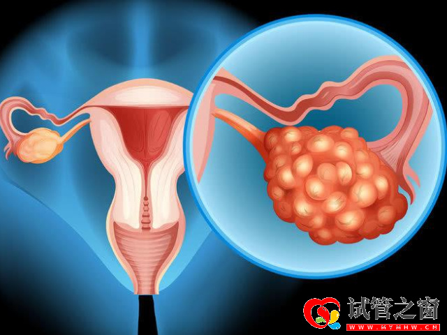 多囊可以進行治療懷孕