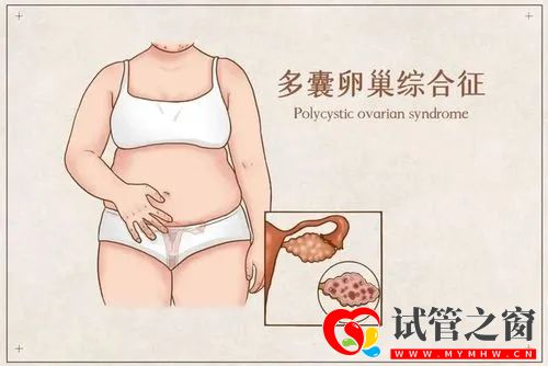 如何防止多囊卵巢復發？(圖1)