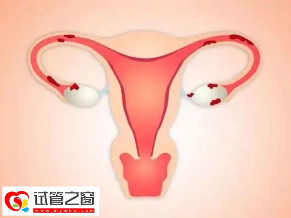 巧克力囊腫會影響宮腔環境