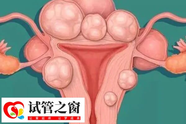 子宮肌瘤試管前可以進(jìn)行治療
