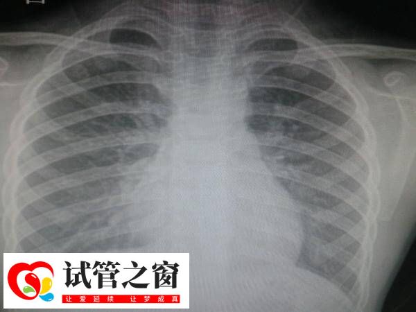 做試管拍胸片是常規體檢項目之一