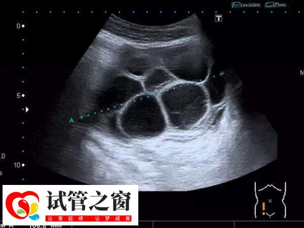 取卵過(guò)度會(huì)造成卵巢過(guò)度刺激癥