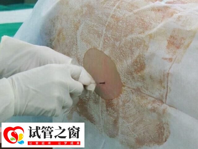 宮腔鏡是一種微創性婦科診療技術