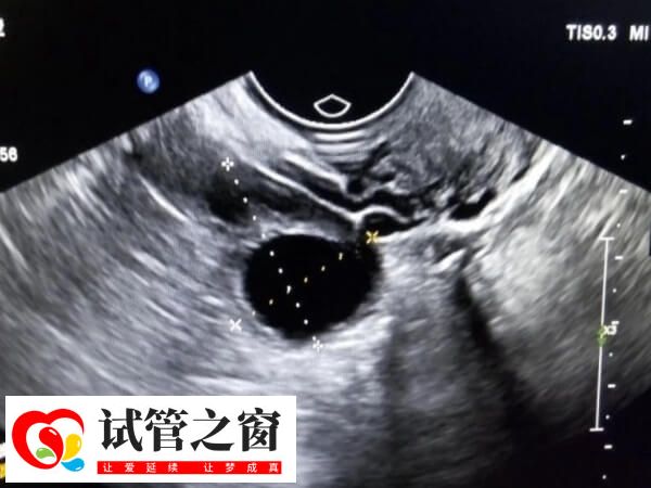 促排卵期間將持續進行卵泡監測